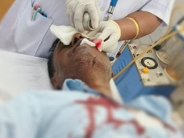 एसईसीएल के सब एरिया मैनेजर पर ग्रामीणों का हमला, गंभीर घायल; सड़क निर्माण के विरोध में हुई ज़ोरदार पत्थरबाजी